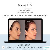 عروض زراعة الشعر