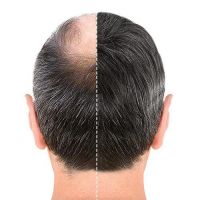 عروض زراعة الشعر